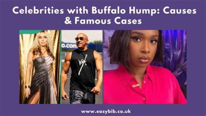Celebrities With Buffalo Hump